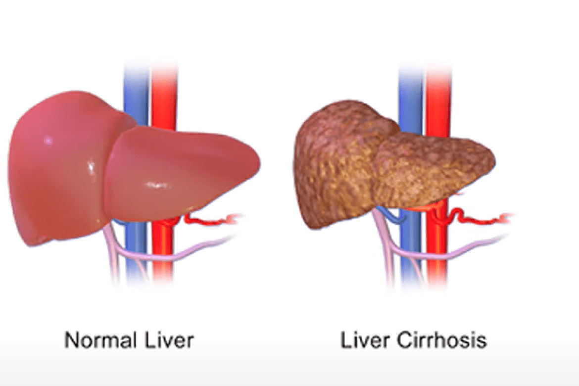 Amelia Tran ’21 won the top award for her video presentation of her research on primary biliary cirrhosis, which she conducted at the Memorial Sloan Kettering Cancer Center.