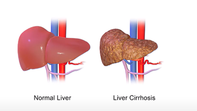 Amelia Tran ’21 won the top award for her video presentation of her research on primary biliary cirrhosis, which she conducted at the Memorial Sloan Kettering Cancer Center.